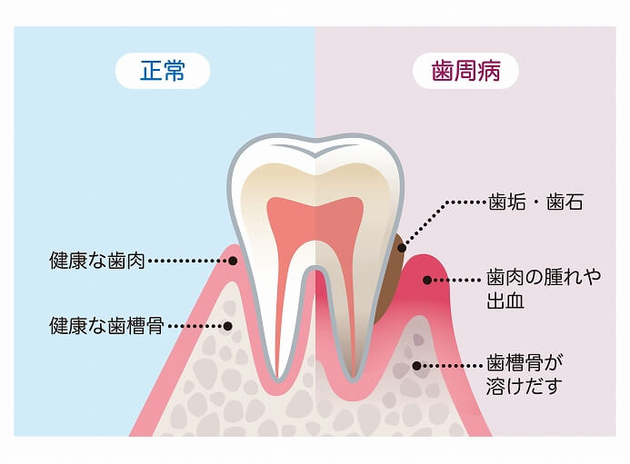 歯周病の治療って？