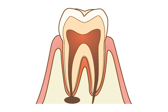 根管治療とは