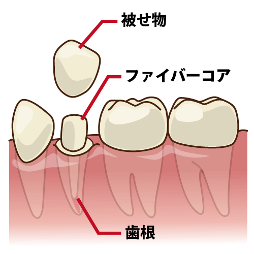 ファイバーコア（被せ物の土台）