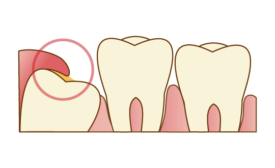 歯ぐきに炎症を起こす