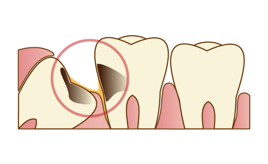 周囲の歯の虫歯や歯周病のリスクが高まる