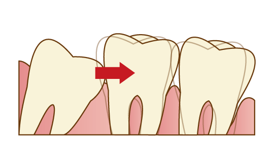歯並びが悪くなる